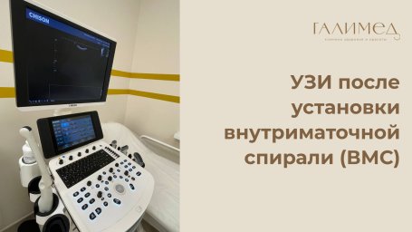 УЗИ после установки внутриматочной спирали (ВМС) в Балашихе УЗИ после установки внутриматочной спирали (ВМС) в Балашихе